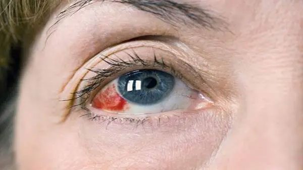 Eye stroke occurs when the veins or arteries of the retina are blocked