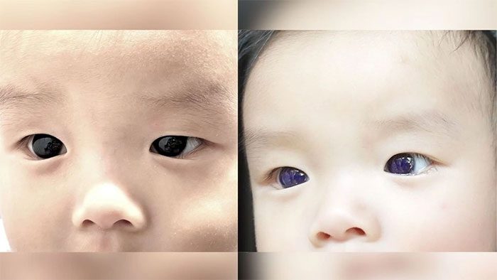  Normally, the baby has brown eyes (left image) and turns to blue eyes (right image) 
