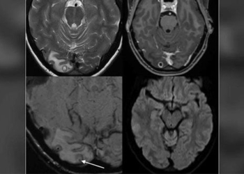 first case of ophidascaris worm infection in humans 129511