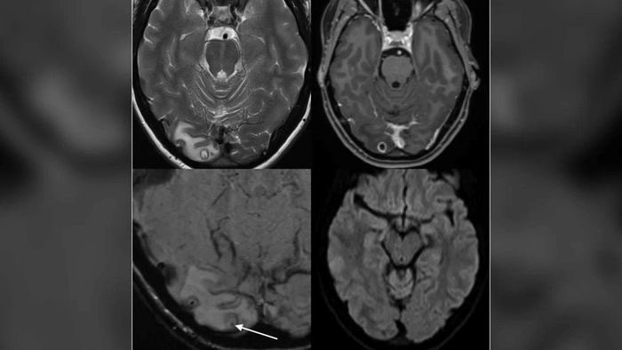 MRI results show a mass containing Ophidascaris larvae in the woman's brain.