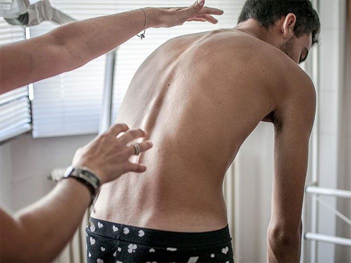 Kyphosis