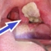 how to differentiate between diphtheria and pharyngitis 106744