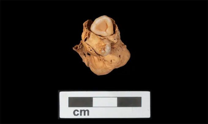 The teratoma with two teeth.