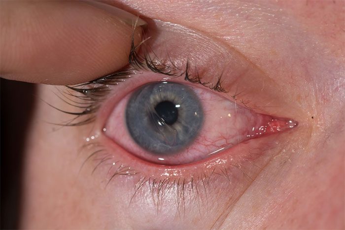 Corneal injury causes redness, watering, or sensitivity to light.