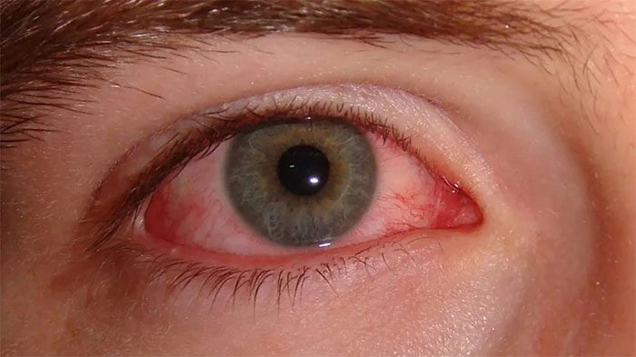 Alcohol can cause bloodshot eyes but it will quickly disappear.