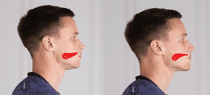 Mewing is a technique that uses tongue positioning to shape the jawline and face.