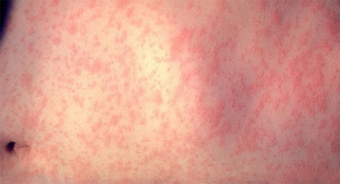 Measles rash.