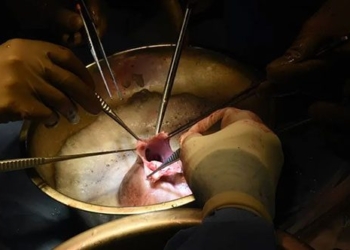 second patient in the world receives heart transplant 130210