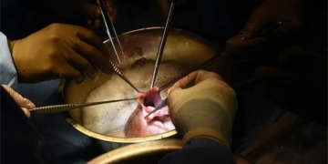 second patient in the world receives heart transplant 130210
