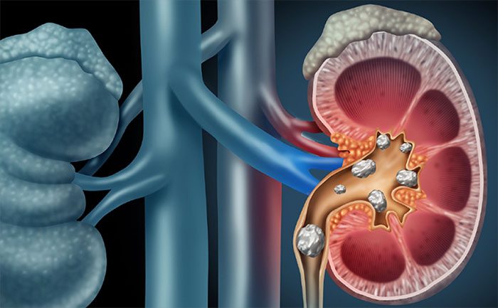 Kidney Stones