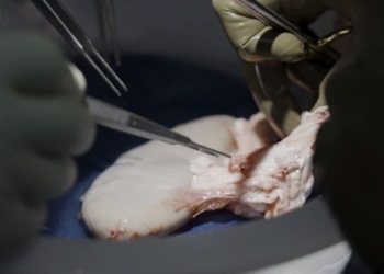 successful graft turns into a large monster gene revolution for patients with brain death 129347