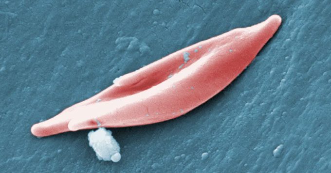 A sickle cell.