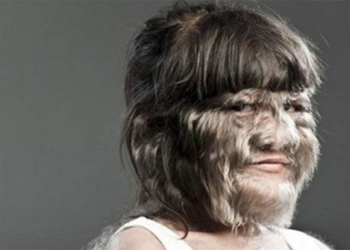 the girl with the rare disease only 50 people in the world have been born with it at adulthood 131313