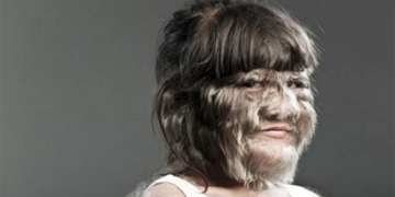 the girl with the rare disease only 50 people in the world have been born with it at adulthood 131313