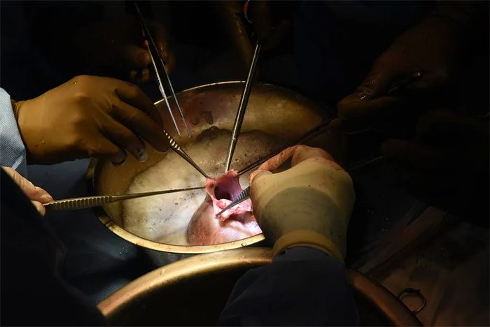 The transplanted organ is a genetically modified pig heart.