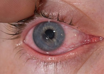 top 10 causes of dark circles and treatment 130222