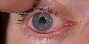 top 10 causes of dark circles and treatment 130222