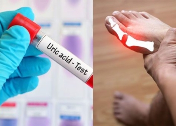 top 10 ways to naturally reduce uric acid and effectively prevent gout that many people dont know about 130786