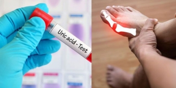 top 10 ways to naturally reduce uric acid and effectively prevent gout that many people dont know about 130786