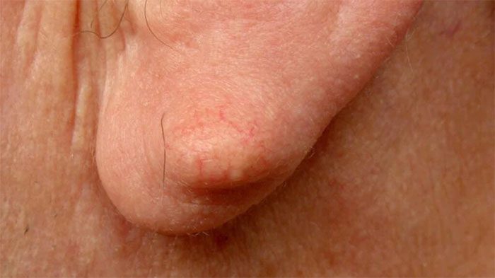 A lump behind the ear may simply be acne