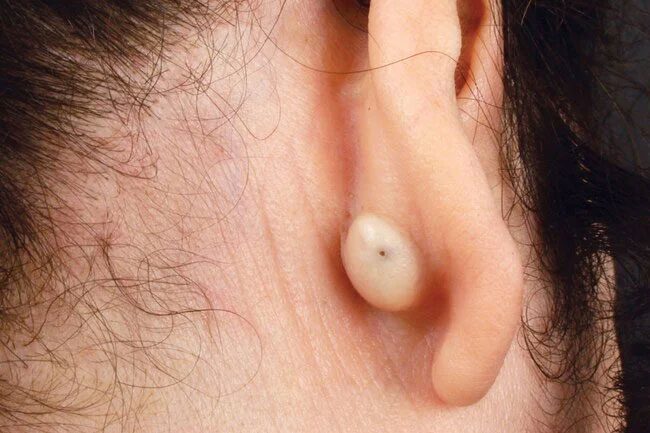 Sebaceous cysts behind the ear are benign