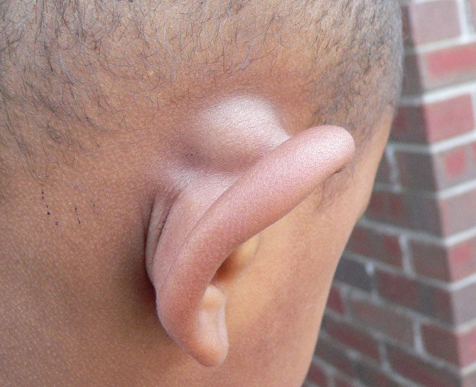 A lipoma behind the ear is soft and doughy to the touch.