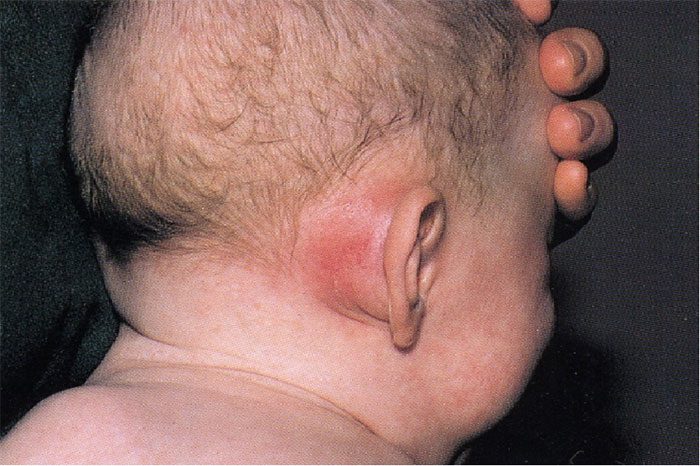 Lumps behind the ear due to mastoiditis often occur in children.