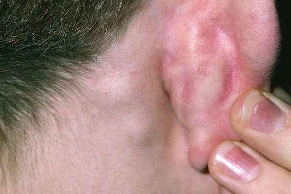 Lumps behind the ear can be due to infection