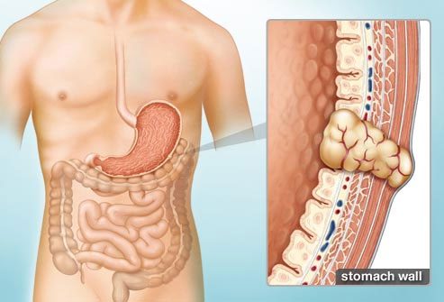 GIST is suspected and detected based on symptoms such as anemia, abdominal pain...