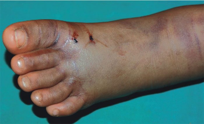 Untreated snake bites can have severe consequences.
