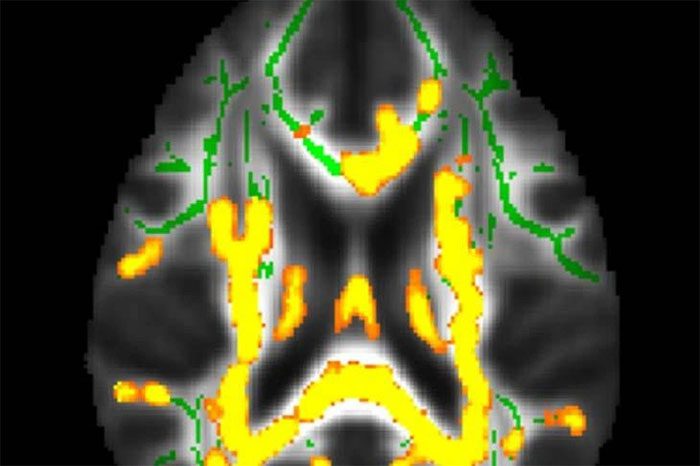 Image showing increased neuroinflammation (in yellow).