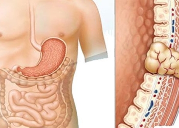 what is bowel obstruction 131259