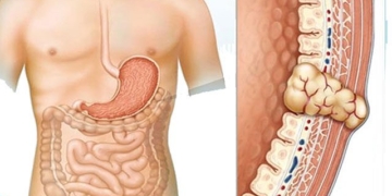 what is bowel obstruction 131259
