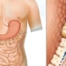 what is bowel obstruction 131259