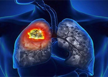 what is silicosis 131304