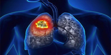 what is silicosis 131304