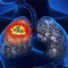 what is silicosis 131304