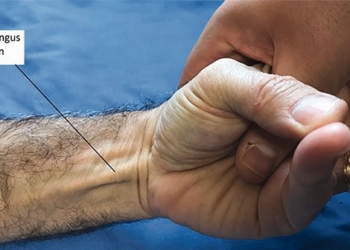 why some people do not have palmaris longus tendon in their hands 129737