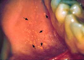 Fordyce Granules on Tongue
