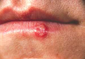 Recurrent Herpes Labialis
