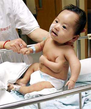 Baby Jie-jie, 59 days old, born at Shanghai Hospital with a congenital condition of three arms