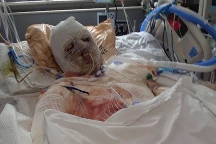 This is the world's first successful face transplant surgery.