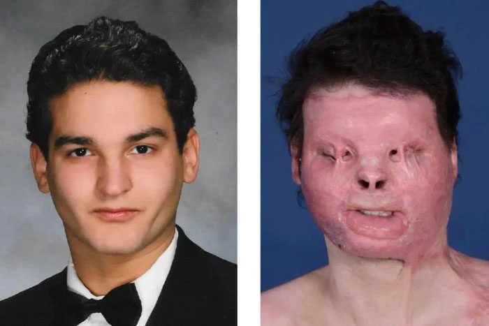 Joe DiMeo before and after the horrific accident.