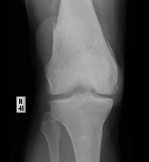 Knee joint X-ray