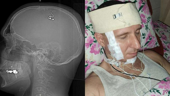 Michael Raduga after self-performing brain surgery.