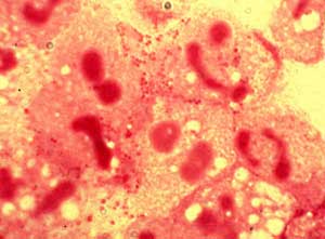 Neisseria meningitidis