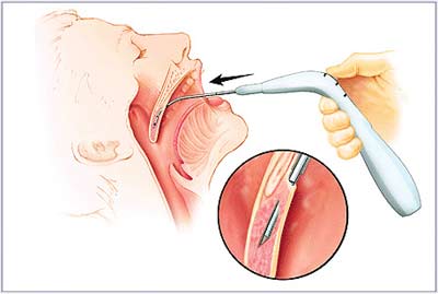 New Pillar Procedure technique