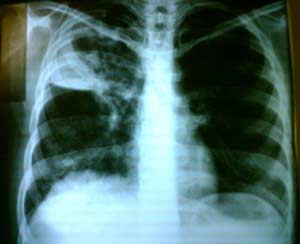 X-ray image of a patient with pulmonary tuberculosis