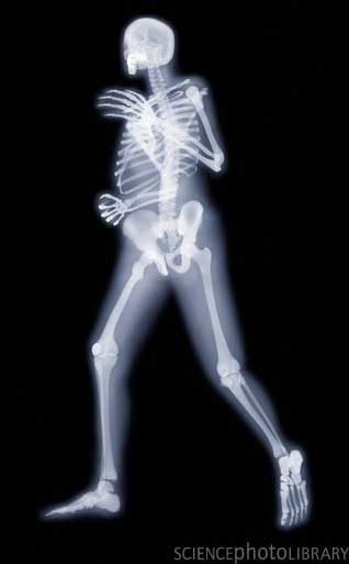 X ray3