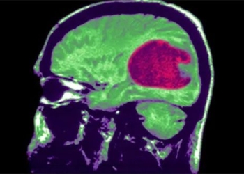 artificial intelligence can treat brain strokes faster and more accurately 128558